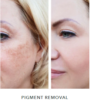 aftercare healing for pigment removal